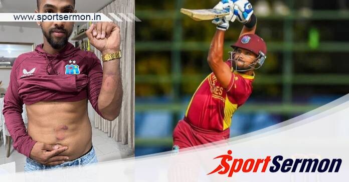 Fans shocked seeing cricketer Nicholas Pooran injuries   Fans shocked seeing cricketer Nicholas Pooran injuries