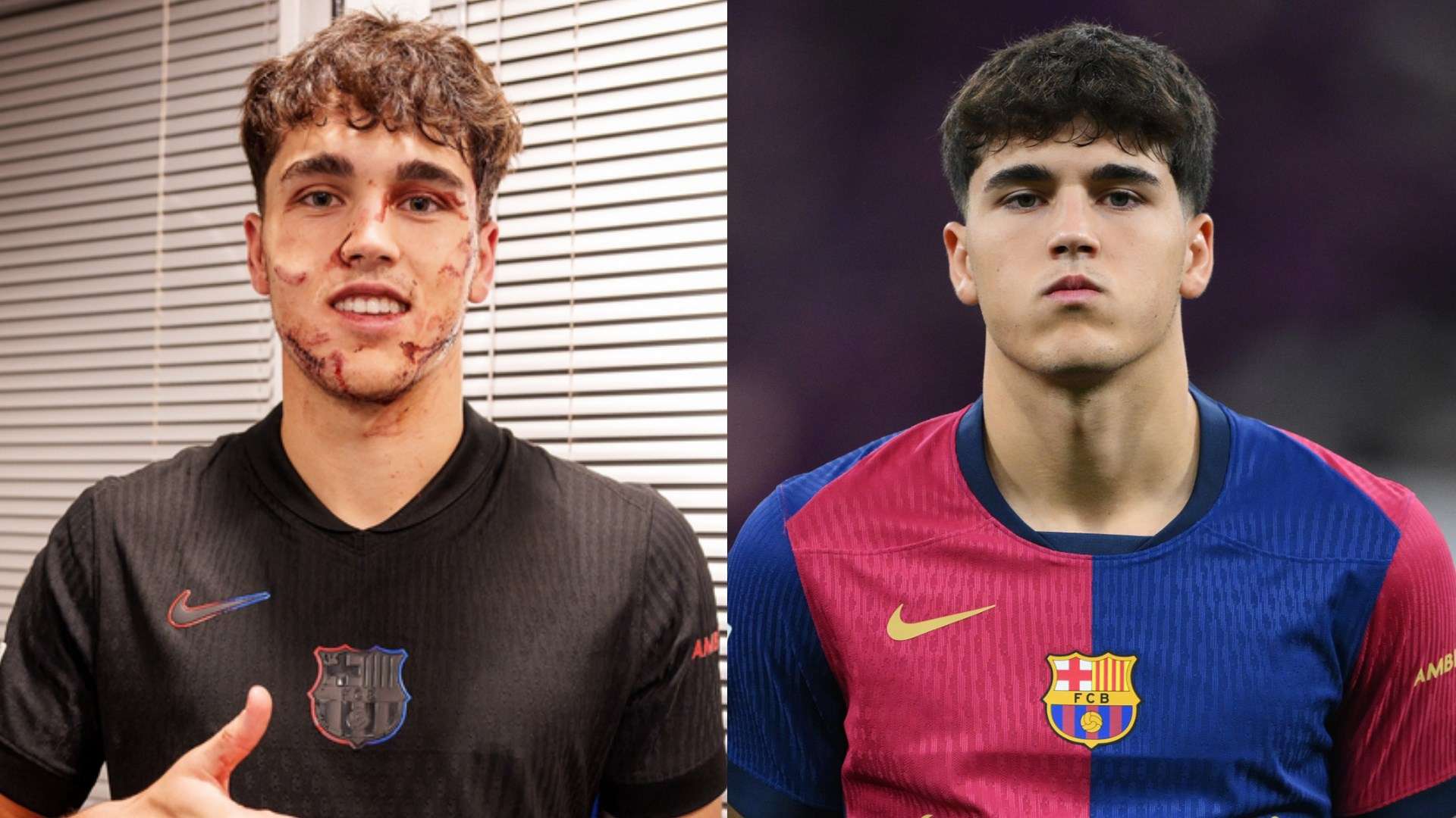 Barca's Cubarsi requires 10 stitches after being kicked in the face  