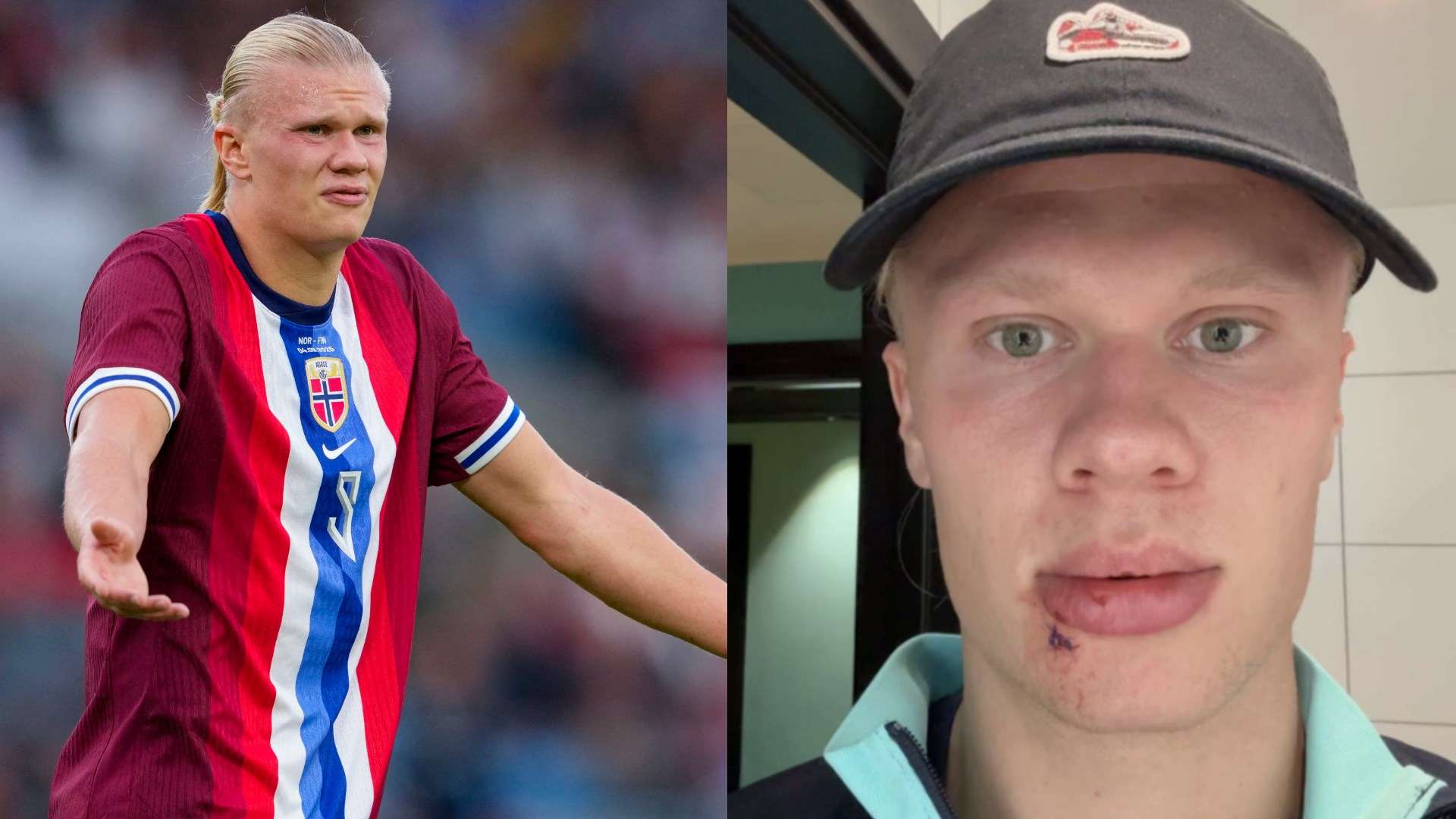 Freak injury leaves bloodied Haaland requiring three stitches  